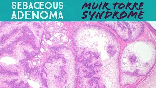 Cystic Sebaceous Adenoma  Clue to Muir Torre Syndrome HNPCC Colorectal Cancer Syndrome Dermpath [upl. by Marilla850]