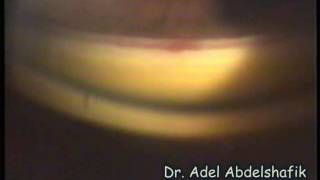 Ophthalmolgy Test yourself gonioscopy 07 [upl. by Aible570]