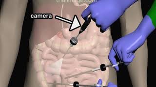 Laparoscopic Appendectomy  Animation by Cal Shipley MD [upl. by Aynas]