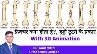 Common types of Bone fracture  Types of Fracture in Hindi  Bones Fracture [upl. by Norehs]