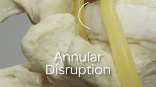 Extrusion and Protrusion Model of Disc Herniation [upl. by Airamas417]