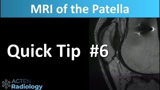 MRI of the Patella The Patellar Calcar [upl. by O'Malley]