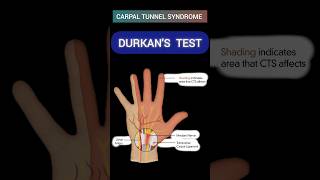 DURKANS TEST for Carpal Tunnel Syndrome🤚carpaltunnelsyndrome anatomy greysanatomy mbbs [upl. by Barrett]