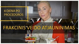 Frakcinis veido atjauninimas  Odos atjauninimas [upl. by Asserak]