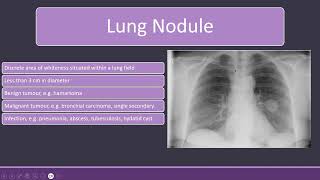 Chest Xray with Lung Nodules and Bronchiectasis radiology [upl. by Milman]