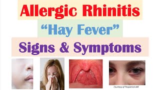 Allergic Rhinitis Hay Fever amp Seasonal Allergies Signs amp Symptoms amp Why They Occur [upl. by Acemat]