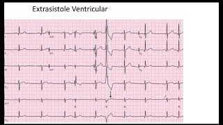 Extrasistole Auricular y Ventricular EKG [upl. by Newbill]