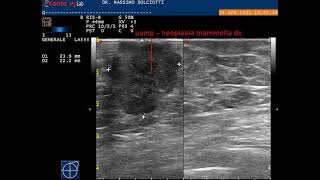 neoplasia mammaria destra nelluomo [upl. by Giliane]