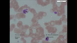 Plasmodium vivax Malaria Schizont [upl. by Ennaillek652]