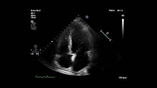 Cardiac Ultrasonogram Showing Apical 4 Chamber View [upl. by Bonucci886]