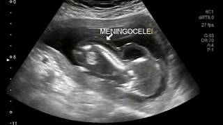 Ultrasound Video showing intrauterine death of fetus with encephalocele and meningocele [upl. by Neumark39]