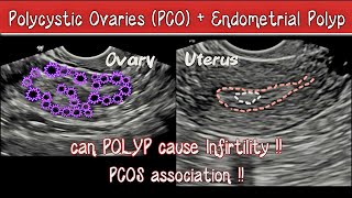 Polycystic Ovaries PCOS  Endometrial Polyp  Cause of Infertility   TVS Ultrasound [upl. by Efar]