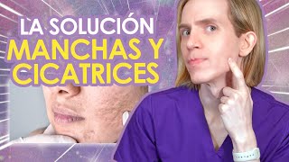 COMO BORRAR MANCHAS Y CICATRICES DE ACNE  Guia paso a paso y guia de productos  Simon Scarano [upl. by Gnaw]