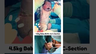 45Kg Big Baby Delivery Via CSection 🥰 trendingshorts baby trendingreels viralvideo pregnancy [upl. by Kauslick]