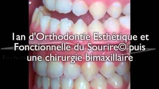 Chirurgie bimaxillaire pour un jeune adulte  correction avec 1an daligneurs® en OEFS© [upl. by Obola]