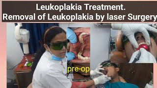 Leukoplakia TreatmentRemoval of Leukoplakia by laser Surgery [upl. by Arutek621]