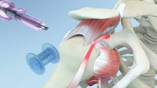 Right Shoulder Rotator Cuff Repair and Biceps Tenodesis Animation [upl. by Champ]