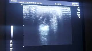 B Scan  Ultrasound eye bilateral hyperplastic primary vitreous [upl. by Iddo266]