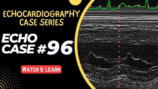 ECHO CASE 96  Echocardiography for Beginners  M Mode Echocardiogram [upl. by Droc]