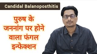 Candidal Balanoposthitis  पुरुष के अंग पर होने वाला फंगल इन्फेक्शन  Fungal infection candida [upl. by Erodeht]