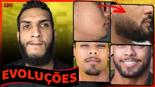 EVOLUÇÕES COM MINOXIDIL  RESULTADOS COM MINOXIDIL 134 [upl. by Eecyak848]