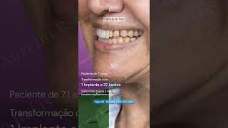 Mais uma transformação incrível realizada no CiR cir dentista facetasdeporcelana odontologia [upl. by Marashio]