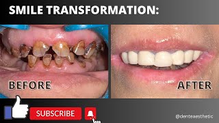 Smile makeover upper arch  PFM bridge rootcanals smilemakeover transformation restoration [upl. by Bennion]