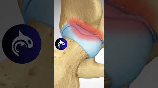 See what a Labral Tear of the Hip looks like in 3D animation hiparthritis arthritis anatomy [upl. by Piks]