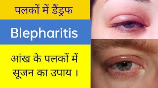 आंख के पलकों में सूजन का क्या उपाय हैं Treatment of Blepharitis Treatment of Eye lids Dandruff [upl. by Ravilob639]