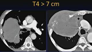 TNM Staging Lung Cancer [upl. by Tania212]