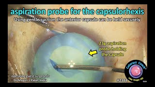 CataractCoach™ 2384 aspiration probe for the capsulorhexis [upl. by Dyche]