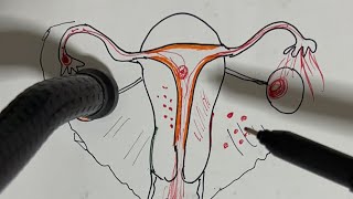 O que é endometriose Tratamento é sintomas [upl. by Dione]