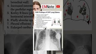 Chest X Ray of Lung Edema medical doctor nursing [upl. by Nodgnal49]