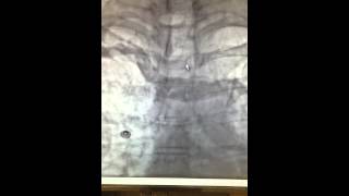 Right sided Venogram [upl. by Mulcahy]