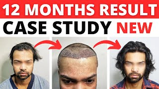 My 12 Months Hair Transplant Result  This Lucky Patient Got An Amazing Hair Transplant Result 2024 [upl. by Esaj934]