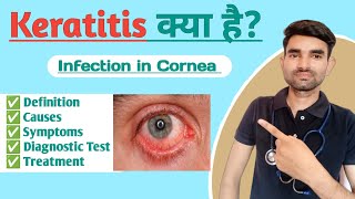 Keratitis Lecture in Hindi  Causes Symptoms and Treatment of Keratitis [upl. by Riggins575]