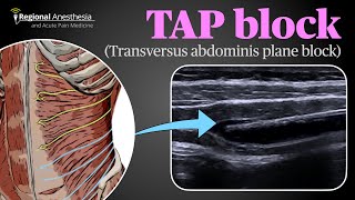 Ultrasound Guided Transversus Abdominis Plane TAP Block [upl. by Aivull599]