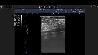 Arterial stenosis by atheromatous plaque [upl. by Dnomaid98]