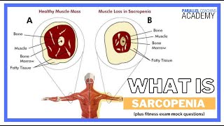 What is Sarcopenia [upl. by Winters]