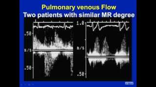 Mitral Regurgitation Revisited  Pitfalls in Severity Assessment [upl. by Lourdes843]