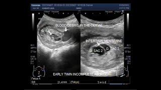 Early Twin Pregnancy with Blighted ovum also called Anembryonic pregnancy [upl. by Oninotna]