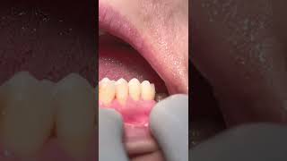 Zirconia crowns satisfying asmr [upl. by Chevy536]