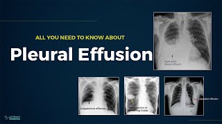 Pleural Effusion  Types Causes Evaluation amp Management All You Need To Know For Exam [upl. by Streeto]