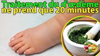 Traitement du Lenflure dans pieds dœdème avec cette méthode simple ne prend que 20 minutes [upl. by Nishi553]