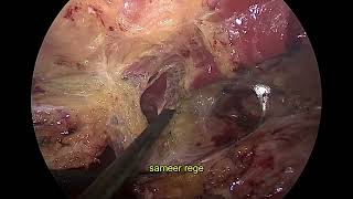 Laparoscopic Etep RS repair for incisional hernia [upl. by Ecinehs122]