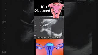 Displaced IUCD Causes Diagnosis and Management shortsbeta yt healthytips DrSaimakhan [upl. by Ynnol]