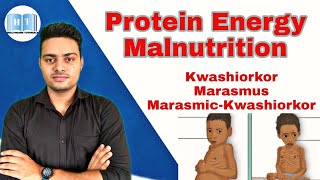 Protein Energy Malnutrition  Kwashiorkor Vs Marasmus [upl. by Olimpia]