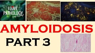 AMYLOIDOSIS PART 3 Morphology Diagnosis Special stains clinical features amp Prognosis [upl. by Hairem722]