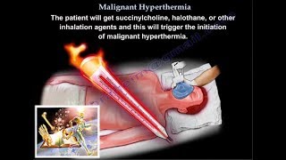 Malignant Hyperthermia  Everything You Need To Know  Dr Nabil Ebraheim [upl. by Aylward420]