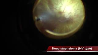 Myopic Foveoschisis with deep staphyloma [upl. by Pavior]